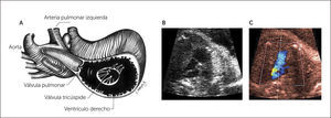 IMAGEN DE TRACTO DE SALIDA DE VENTRÍCULO DERECHO A Esquema, B imagen modo B, C imagen Doppler color. Ao= aorta; Pulmonar= arteria pulmonar y sus dos ramas.