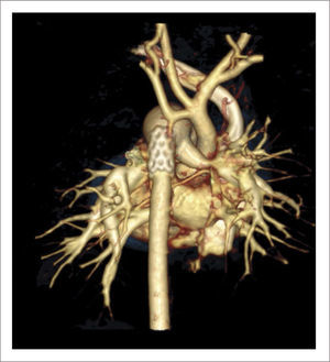 TOMOGRAFÍA AXIAL COMPUTADA ARCO AÓRTICO Tomografía axial computada que muestra arco aórtico hipoplásico, con coartación crítica e hipoplasia del arco, post implante de stent ductal Banding de arteria pulmonar izquierda, y posterior a stent se ve parcialmente banding de arteria pulmonar derecha.
