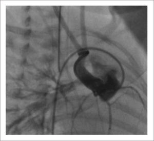 ANGIOGRAFÍA MOSTRANDO TRONCO ARTERIOSO CON INTERRUPCIÓN DEL ARCO AÓRTICO EN PERIODO DE RECIÉN NACIDO.