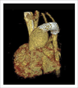 TOMOGRAFÍA COMPUTADA IMPLANTE STENT DUCTAL Muestra resultado post implante de stent ductal y banding de arterias pulmonares.