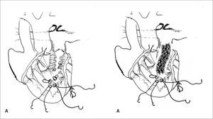 DIAGRAMA MUESTRA TÉCNICA DE IMPLANTE DE STENT EN TRACTO DE SALIDA DE VENTRÍCULO DERECHO A: Acceso perventricular por esternotomía. B: Stent implantado. Autores: Drs. Guillermo Zamora, Francisco Boye y Luis Sánchez.