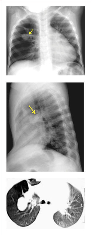ATRESIA BRONQUIAL Lactante de 2 años con historia de cuadros bronquiales obstructivos a repetición. Rx Tx y TAC pulmonar demuestran una masa pulmonar derecha compatible con una Atresia bronquial.