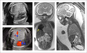 MALFORMACIÓN CONGÉNITA DE LA VÍA AÉREA PULMONAR Imagen ecográfica antenatal y RNM fetal que muestra una masa toráxica que desplaza el mediastino y signos de hídrops fetal.