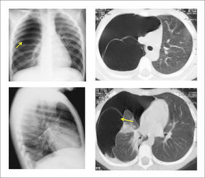 MALFORMACIÓN CONGÉNITA DE LA VÍA AÉREA PULMONAR TIPO IV EN PREESCOLAR DE 4 AÑOS Imagen radiológica y TAC pulmonar.
