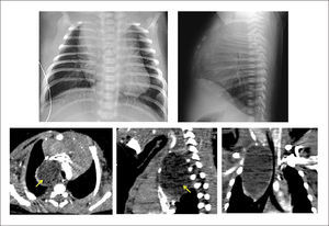 QUISTE BRONCOGÉNICO RN que evoluciona con SDR, cianosis y estridor desde las 6 horas de vida y con un Sd. De Claude Bernard Horner. Imagen radiológica y confirmación por TAC de tórax.