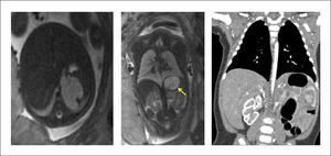 SECUESTRO PULMONAR EXTRALOBAR INFRADIAFRAGMÁTICO Diagnóstico prenatal por resonancia magnética fetal.