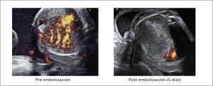 MANEJO ANTENATAL DE UNA MALFORMACIÓN CONGÉNITA DE LA VÍA AÉREA PULMONAR Se visualiza imagen doppler previo a embolización arterial y 5 días después (28 semanas de gestación).