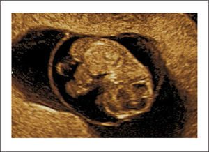 HERNIA FISIOLÓGICA. EMBRIÓN DE PRIMER TRIMESTRE HERNIA FISIOLÓGICA.