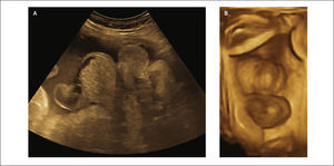 EXTROFIA VESICAL Se observa zona de defecto infra umbilical, y ausencia de vejiga, a) imagen ultrasonido modo B, b) Imagen 3D.