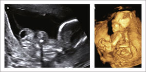 LIMB BODY WALL COMPLEX (COMPLEJO MIEMBRO-PARED) Se observa defecto amplio de pared abdominal y deformación de columna, a) modo B, b) imagen 3D.