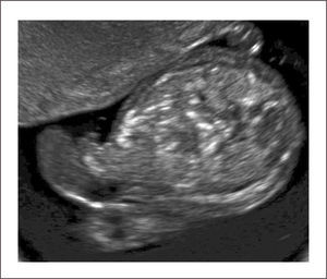 ONFALOCELE PEQUEÑO Se observa asas intestinales en saco.