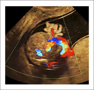 GASTROSQUISIS Se observa plano axial de abdomen con defecto para umbilical. Inserción de cordón umbilical indemne.