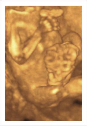 GASTROSQUISIS Se observa protrusión de asas intestinales por defecto, en feto de 12 s.