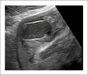 GASTROSQUISIS Se observan asas intestinales dilatadas.