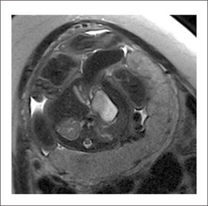 GASTROSQUISIS Resonancia magnética, se observa dilatación de asa de intestino grueso.