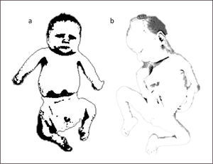 RECIÉN NACIDO CON AMIOPLASIA a. Recién nacido con amioplasia. Compromiso simétrico de extremidades superiores e inferiores. Extremidades superiores con codos extendidos y rotación interna de hombros. Muñecas en flexión. Pies en equino-varo. b. Artrogriposis múltiple congénita. Deformación severa de articulaciones en extremidades superiores con flexión de codos y pie equino.