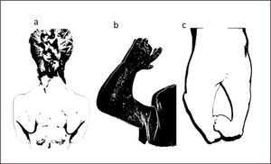 SINDROME DE PTERIGIUM a.Pterigium colli. b.Pterigium codo c.Pterigium poplíteo en ambas rodillas.