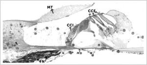 SECCIÓN DEL HUESO TEMPORAL HUMANO A NIVEL DEL ÓRGANO DE CORTI MT: Membrana tectoria. CCE: Células ciliadas externas. CCI: Célula ciliada interna. FN: Fibras nerviosas. MB: Membrana basilar.