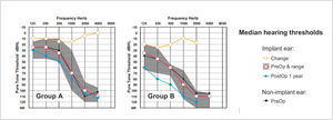 MEDIAN PRE- AND POSTOPERATIVE THRESHOLDS FOR TWO GROUPS OF COCHLEAR SLIM STRAIGHT ELECTRODE RECIPIENTS N was 11 and 13 in groups A and B respectively. Redrawn from Skarzynski et al.26.