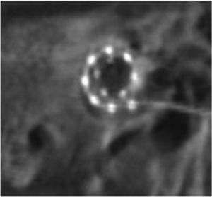 ELECTRODO RECTO FLEXIBLE MED EL. ESTUDIO MEDIANTE TOMOGRAFÍA AXIAL DE ALTA RESOLUCIÓN