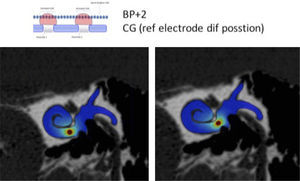 REPRESENTACIÓN DE 2 ELECTRODOS BASALES Y SU SISTEMA DE ESTIMULACIÓN BIPOLAR
