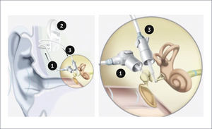 ESTEEM IMPLANT®: ENVOY MEDICAL 1. Sensor capta las vibraciones cadena y las transforma en señales eléctricas que envía al procesador 2. Procesador: recibe la señal, la amplifica y envía al 3. Driver: traduce la señal en vibraciones y las envía a la cóclea.