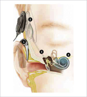 IMPLANTE COCLEAR 1. Los micrófonos del procesador de sonido captan los sonidos y los convierten en señales digitales. 2. La información digital se transmite al receptor interno alojado en la escama del hueso temporal. 3. El implante envía señales eléctricas a los electrodos situados en la cóclea. 4. Las neuronas del ganglio espiral reciben estas señales y las envían al cerebro para su procesamiento.