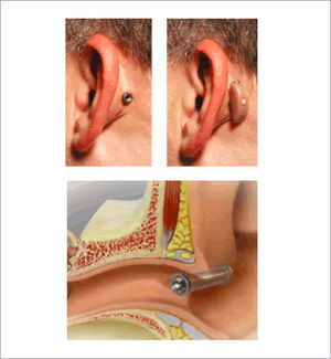 RETRO X TRANSCUTANEOUS AIR CONDUCTION HEARING AID SYSTEM También encontramos en este tipo de prótesis semi implantables 2 sistemas de Cochlear Corp TM Cochlear METR® y Cochlear Codacs™.