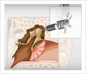 COCHLEAR MET®: EL PERCUTOR MUEVE LA CADENA OSICULAR, TRANSFORMANDO LA SEÑAL ACÚSTICA RECIBIDA EN LA SEÑAL MECÁNICA