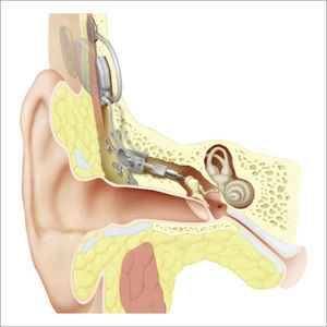 CARINA® DE COCHLEAR CORP. TOTALMENTE IMPLANTABLE