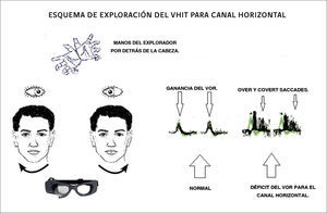 CATCH UP SACCADES Y VHIT El esquema representa a izquierda cómo deben colocarse las manos del examinador por detrás de la cabeza del paciente para realizar los movimientos rápidos. Cuando la cabeza gira a derecha el ojo se desplaza en sentido contrario y lo debe hacer a la misma velocidad y amplitud y viceversa cuando el desplazamiento cefálico es provocado a izquierda. Esta relación entre la amplitud y velocidad de los ojos con respecto a los de la cabeza se puede medir por el VHIT. Cuando el movimiento ocular se produce a menos velocidad que la que se genera a la cabeza tiene movimientos sacádicos recorrectivos que se grafican como se observa a la derecha y permite cuantificar el déficit del VOR.