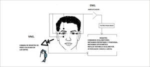 REGISTRO DE MOVIMIENTOS OCULARES. El esquema representa el registro de los movimientos oculares para registrar las funciones del sistema vestíbulo oculomotor. A derecha (ENG) la colocación de electrodos de piel que registran la diferencia de potencial corneo-retina, que se amplifican y se filtran para registrar la actividad oculomotora, espontánea e inducida. A izquierda se representa la VNG que utiliza cámaras que captan los movimientos oculares en sustitución de los electrodos de piel.