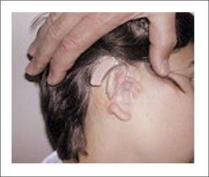 ATRESIOPLASTÍA PARA COLOCACIÓN DE AUDÍFONO TRANSCANAL