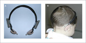 BONE ACHORED HEARING AID (BAHA®) A) Vincha con dos procesadores de B.A.H.A.® B) Niño con microtia y vincha ósea.