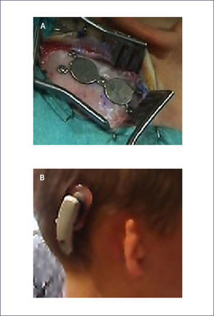 SOPHONO® A) Sophono® imanes sujeto al cráneo por 5 tornillos. B) Sophono conectado al procesador externo.