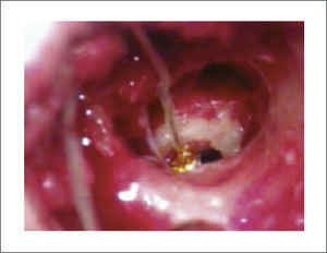 VIBRANT®: TAMBOR SOBRE VENTANA REDONDA A TRAVÉS DE TIMPANOSTOMÍA POSTERIOR