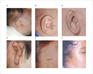 GRADOS DE DISMORFIA DEL PABELLÓN AURICULAR A) Mamelones preauriculares; B) Microtia de 1° grado; C) Microtia de 2° grado; D) Microtia de 3° grado; E) Sólo lóbulo; F) Anotia.