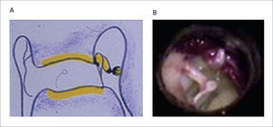 MALFORMACIÓN MENOR DE GRADO I A) Esquema con CAE normal B) Ausencia de la descendente del yunque.