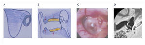 MALFORMACIÓN MENOR GRADO II A) y B) Esquema de hipertrofia del hueso timpanal. C) Imagen otoscópica con fibra óptica, muestra (1) mango de martillo fijo a la pared anterior del CAE, (2) barra del martillo. D) Malformación del martillo.
