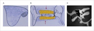 MALFORMACIÓN MAYOR GRADO III A) y B) Hipertrofia del hueso timpanal con reabsorción central parcial; C) Estrechez del CAE. y ocupación con densidad de partes blandas (colesteatoma).