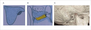 MALFORMACIÓN MAYOR DE GRADO IV A) y B) Esquema con hueso timpanal amorfo y compacto; C) Corte sagital de tomografía en 3D, muestra hueso timpanal compacto, no canalizado.