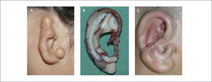 AURICULOPLASTÍA CON CARTÍLAGO COSTAL A) Microtia grado 3; B) Molde y tallado de cartílago. C) Reconstrucción con cartílago costa, foto cortesía Dra. Fernanda Valotta.