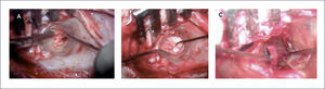 ATRESIOPLASTÍA A) Fresado de la placa atrésica formando el neoconducto; B) Condrotimpanoplastia; C) Tapizado con injerto de piel el neoconducto y el neotímpano.