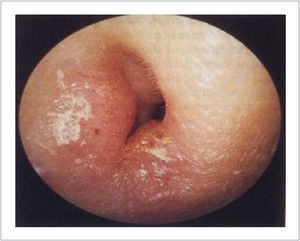 OTITIS EXTERNA DIFUSA.