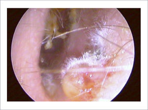 OTITIS EXTERNA MICÓTICA.