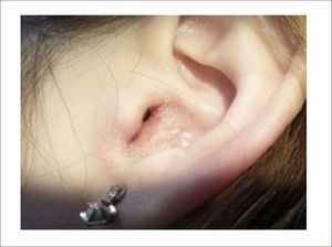 OTITIS EXTERNA ECCEMATOSA.