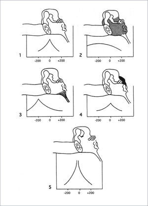 TIPOS DE IMPEDANCIOMETRÍA