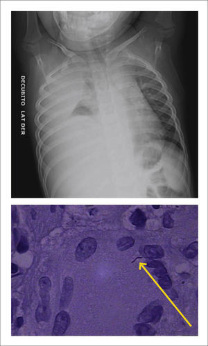 TBC PLEURAL