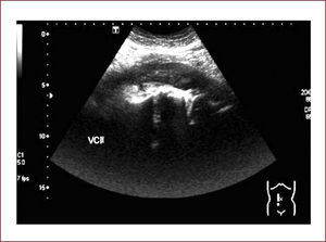 IMAGEN LONGITUDINAL DE LA VCI Se observa la vena cava inferior distendida, con contorno irregular y con material ecogénico en su interior.