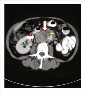 CORTE AXIAL DE TC Se observa un conglomerado de adenopatías retroperitoneales entre la VCI (flechas) y la aorta abdominal (asterisco).